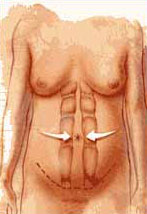 Chirugia addome - I muscoli addominali vengono riavvicinati e cuciti